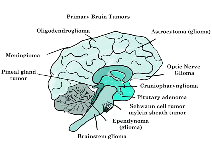 Different categories of brain tumors