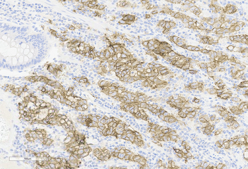 Immunohistochemistry (Formalin/PFA-fixed paraffin-embedded sections) -Recombinant Monoclonal Anti-Claudin-18.2 Antibody, Mouse (3B10) (HCS-S278)Human Gastric Cancer, 20X
