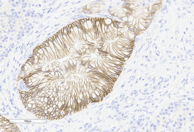 Immunohistochemistry (Formalin/PFA-fixed paraffin-embedded sections) -Recombinant Monoclonal Anti-Claudin-18.2 Antibody, Mouse (3B10) (HCS-S278)Human Pancreatic Cancer, 20X