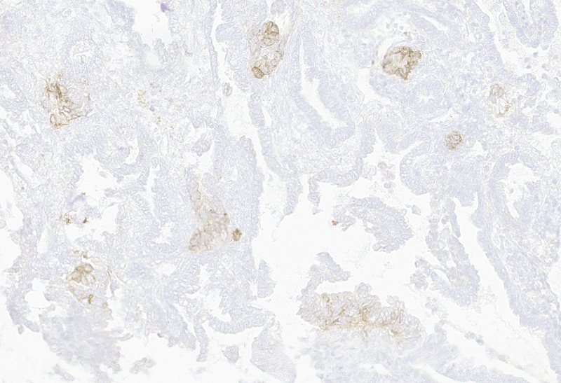 Immunohistochemistry (Formalin/PFA-fixed paraffin-embedded sections) -Recombinant Monoclonal Anti-Claudin-18.2 Antibody, Mouse (3B10) (HCS-S278)Human Ovarian Cancer, 20X